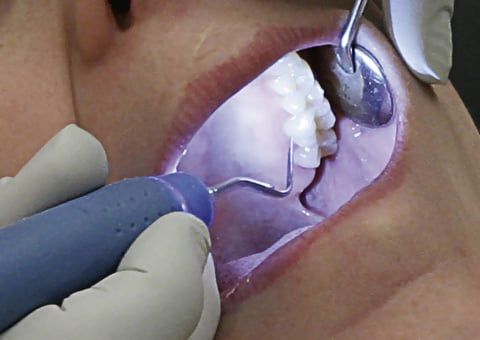 Man getting his teeth scaled